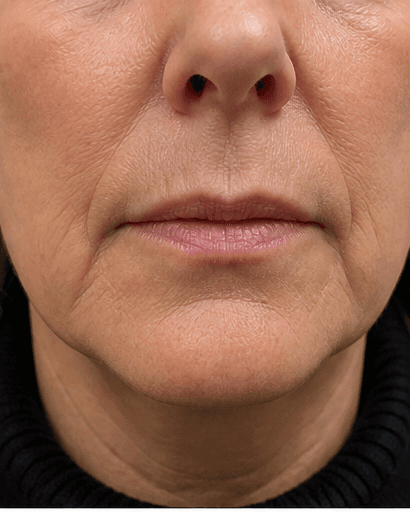 Perioral Line Treatment: before
