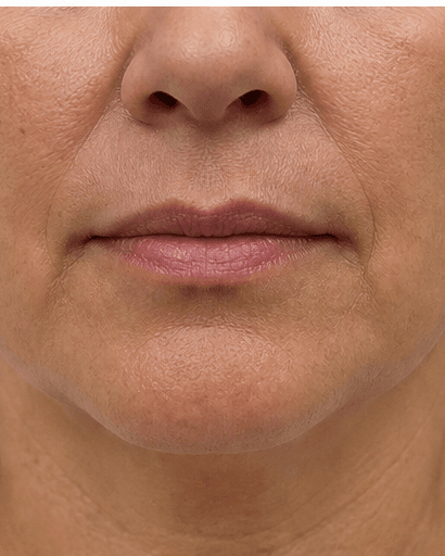 Perioral Line Treatment: after
