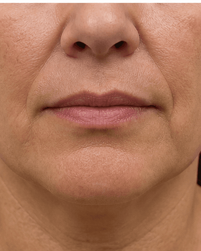 Perioral Line Treatment: before