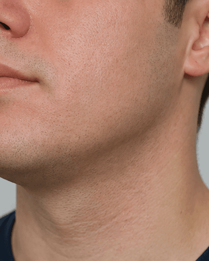 Shaving Acne & Ingrowns: after