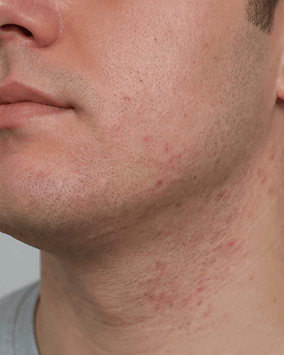Shaving Acne & Ingrowns: before