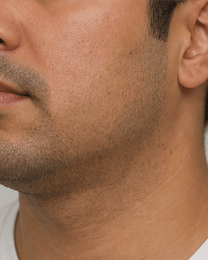 Shaving Acne & Ingrowns: after