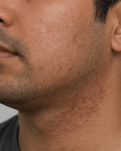 Shaving Acne & Ingrowns: before