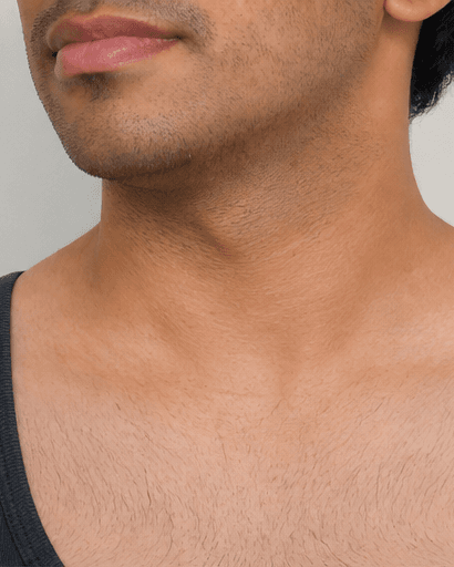 Men's Body Hair Reduction: after