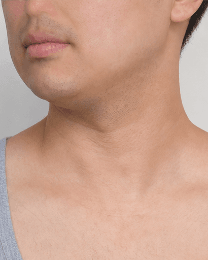 Men's Body Hair Reduction: after