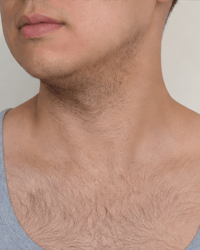 Men's Body Hair Reduction: before