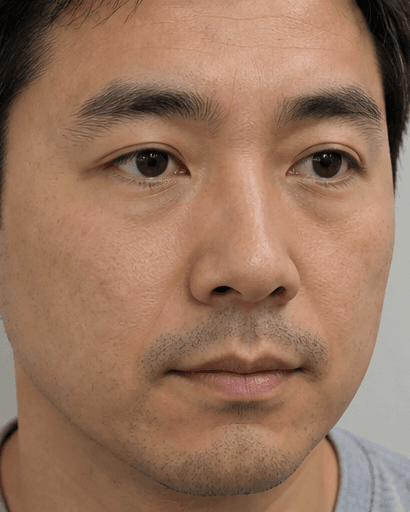Men's Under-Eye Treatment: after