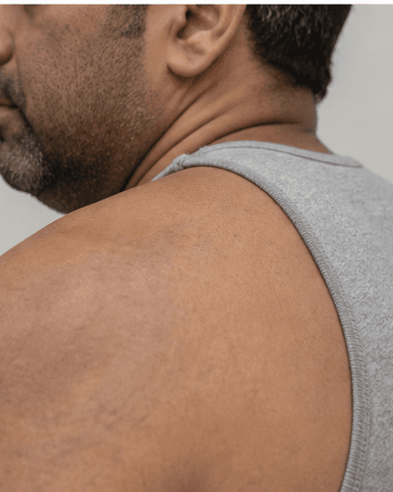 Tattoo Removal: after