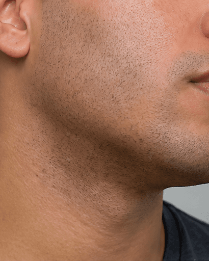 Razor Bump Treatment: after
