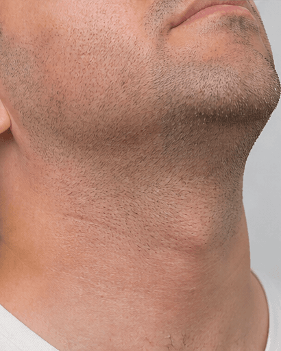 Razor Bump Treatment: after