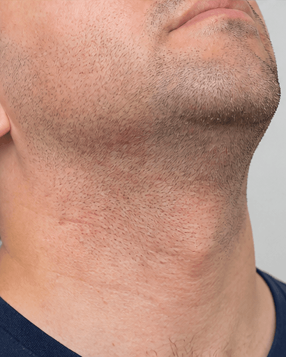 Razor Bump Treatment: before