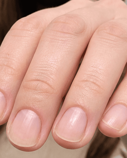 Brittle Nail Investigation: after