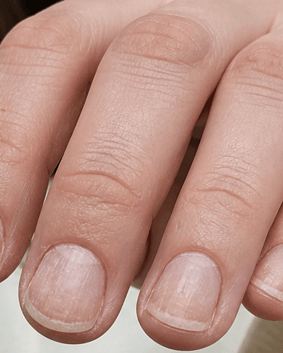 Brittle Nail Investigation: before
