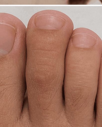 Brittle Nail Investigation: after