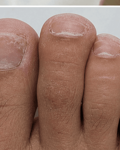 Brittle Nail Investigation: before