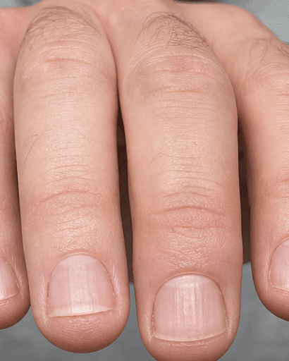 Fungal Nail Treatment: after