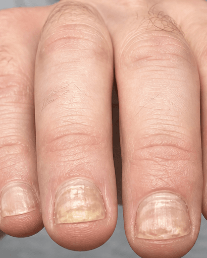 Fungal Nail Treatment: before
