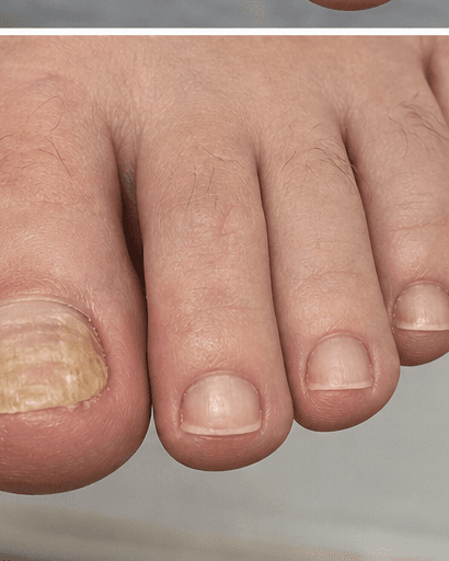 Fungal Nail Treatment: before