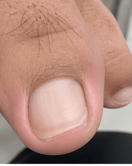Ingrown Toenail Procedure: after