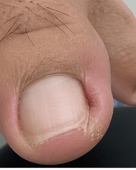 Ingrown Toenail Procedure: before