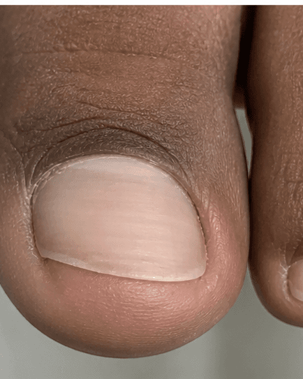 Ingrown Toenail Procedure: after