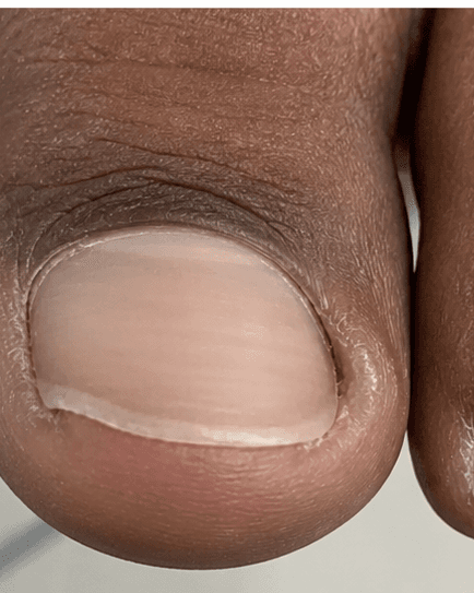 Ingrown Toenail Procedure: before
