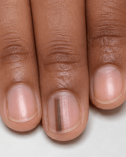 Nail Pigment Band Review: before