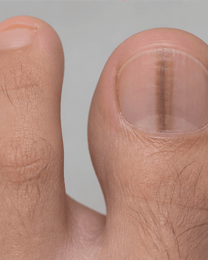 Nail Pigment Band Review: before