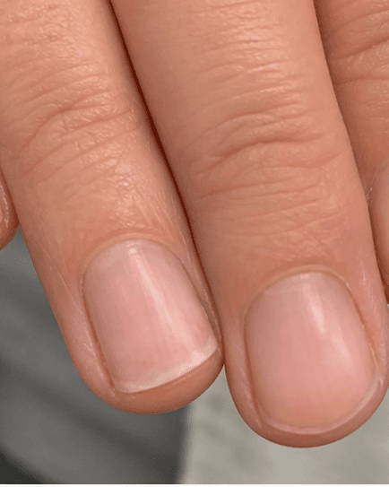 Nail Trauma Repair: after