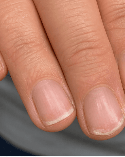 Nail Trauma Repair: before