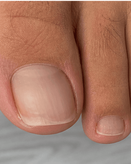 Nail Trauma Repair: after