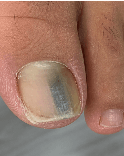 Nail Trauma Repair: before