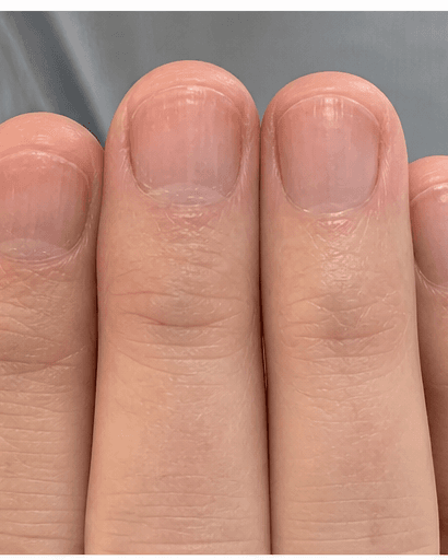 Nail Psoriasis Care: after