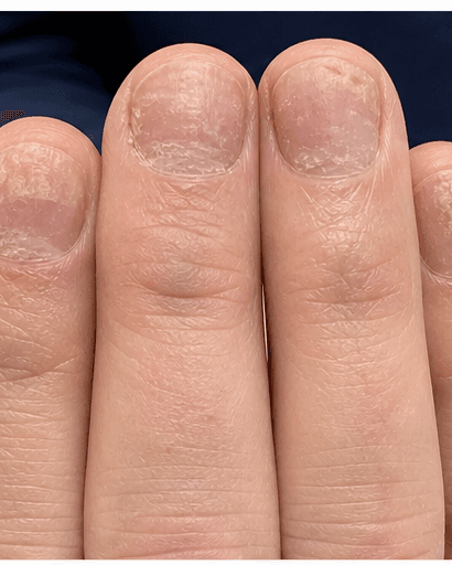 Nail Psoriasis Care: before