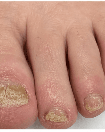 Nail Psoriasis Care: before