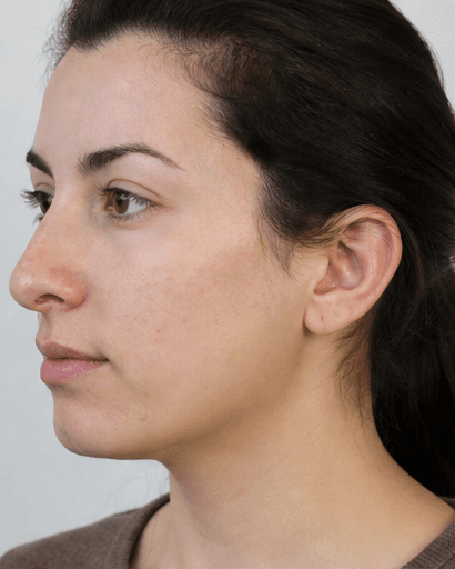 Liquid Rhinoplasty: after