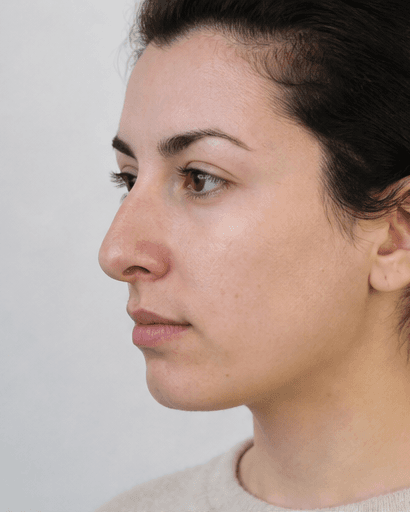 Liquid Rhinoplasty: before