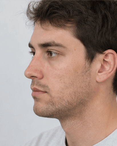 Liquid Rhinoplasty: before
