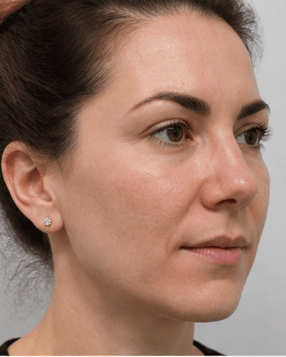 Nose Thread Lift: after