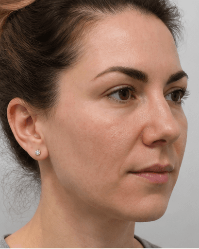 Nose Thread Lift: before