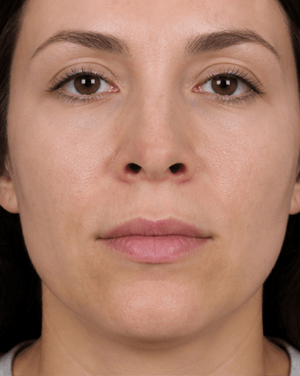 Nostril Slimming: after