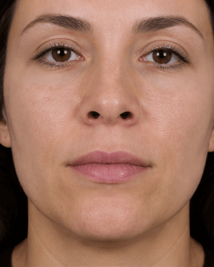 Nostril Slimming: before