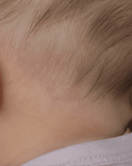 Infant Birthmark Review: after