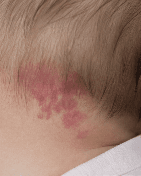 Infant Birthmark Review: before
