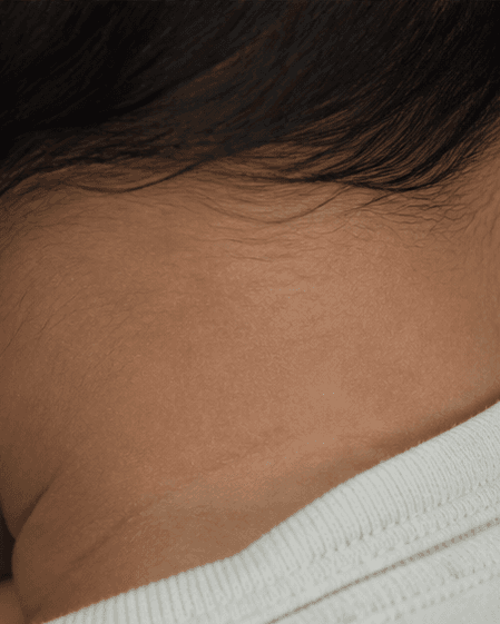 Infant Birthmark Review: after