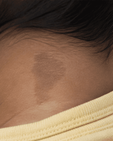 Infant Birthmark Review: before