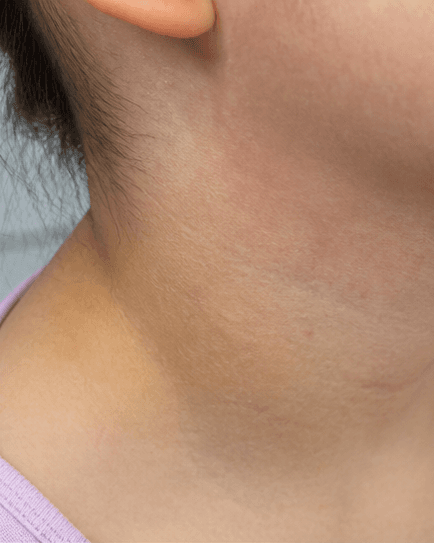 Childhood Eczema Care: after