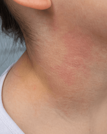 Childhood Eczema Care: before