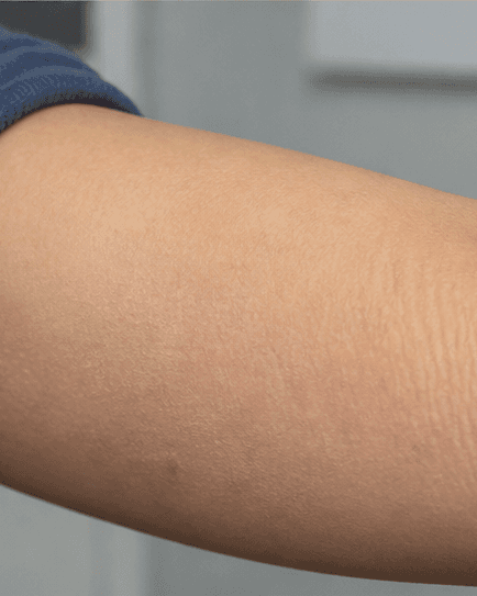 Childhood Eczema Care: after