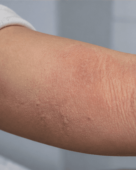 Childhood Eczema Care: before